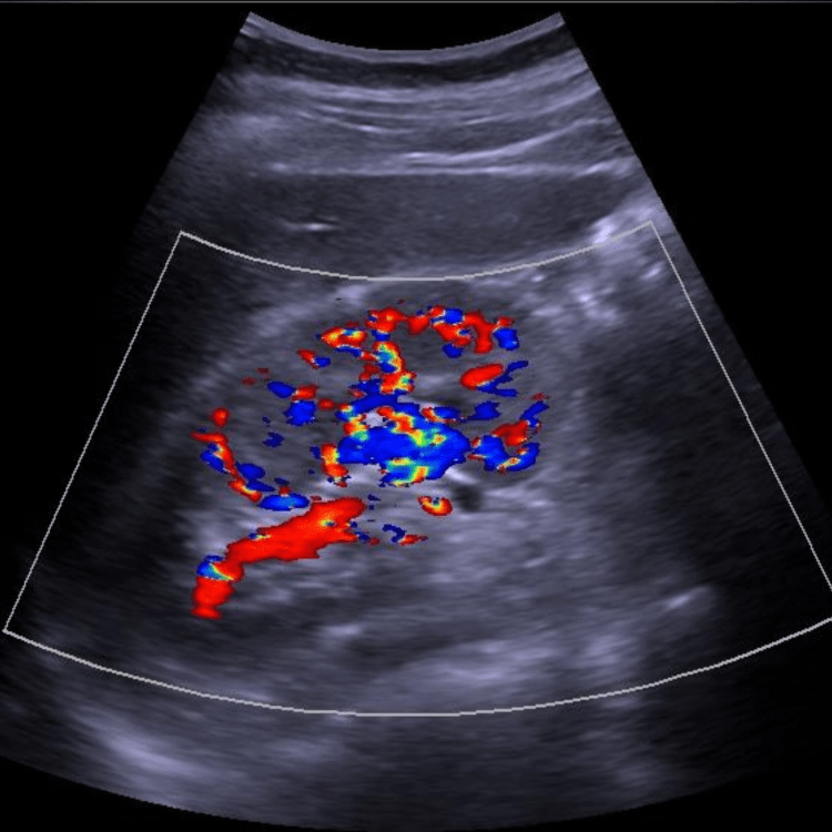 Doppler renal
